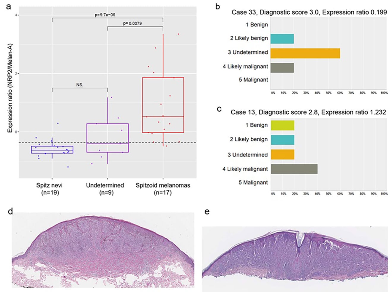 Molecular Signatures and Biomarker Discovery for Melanoma